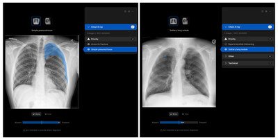 Manipal Hospitals Adopts Harrison.ai’s chest X-ray AI to improve patient outcomes Manipal Hospitals Adopts Harrison.ai’s chest X-ray AI to improve patient outcomes